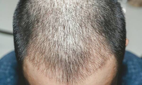 نشانه های عفونت بعد از کاشت مو