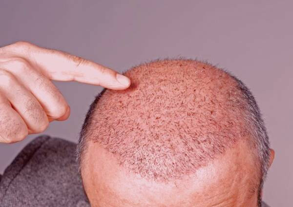 عفونت بعد از کاشت مو