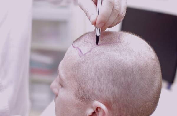 درمان عفونت بعد از کاشت مو