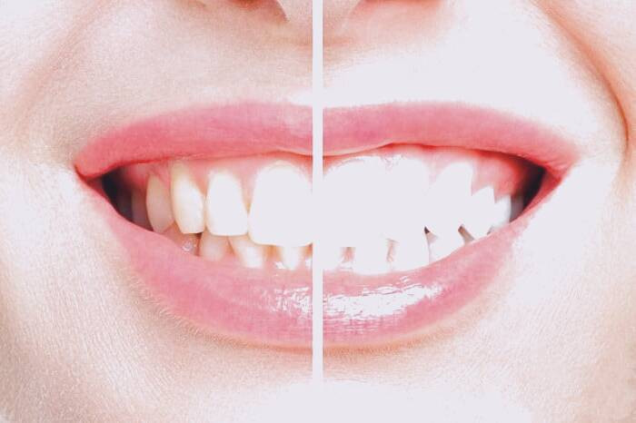 روش سفید کردن دندان 