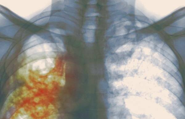 بررسی بیماری سل و آگاهی از علائم آن