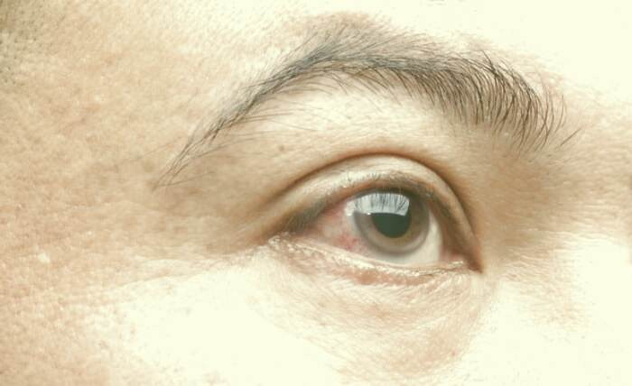 درمان خونریزی زیر ملتحمه چشم 