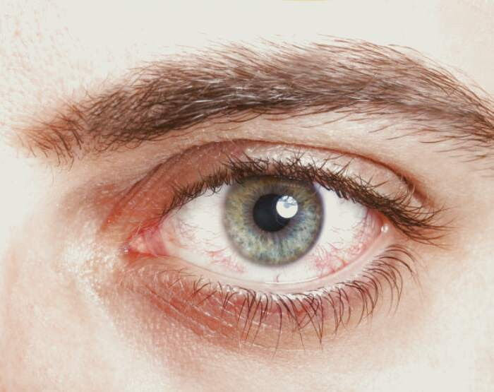 علت لکه خون در چشم