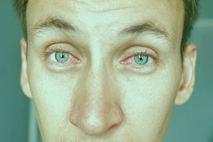 علل لکه خون در چشم