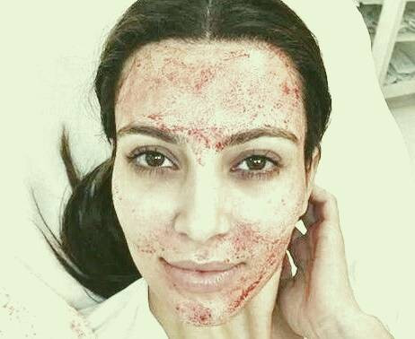 لیزر فرکشنال 