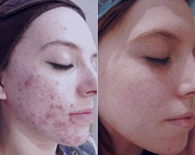 لیزر فرکشنال 