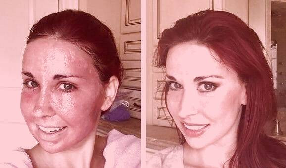 لیزر فرکشنال 