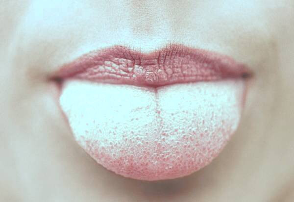 بیماری زبان