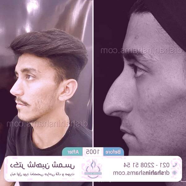 عمل بینی مردانه