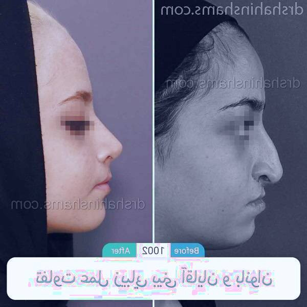 عمل زیبایی بینی