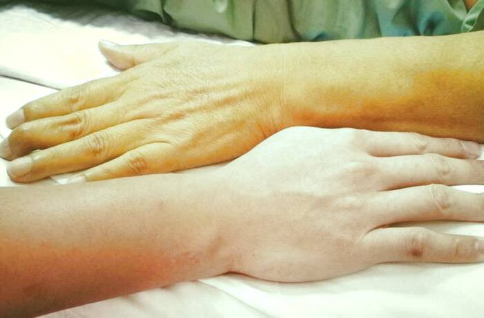 انواع بیماری یرقان