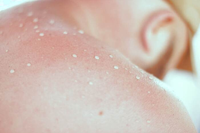 درمان آفتاب سوختگی