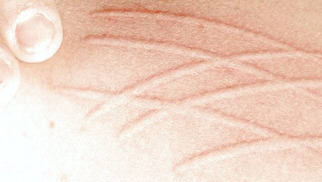 درماتوگرافی