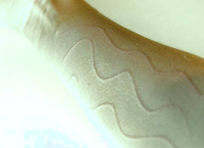 درماتوگرافی سفید