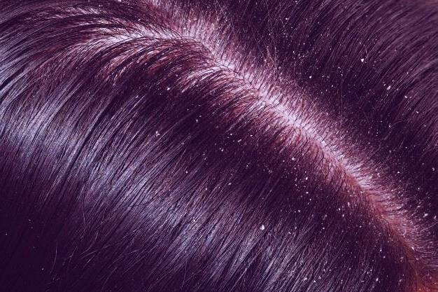 درمان شوره سر 