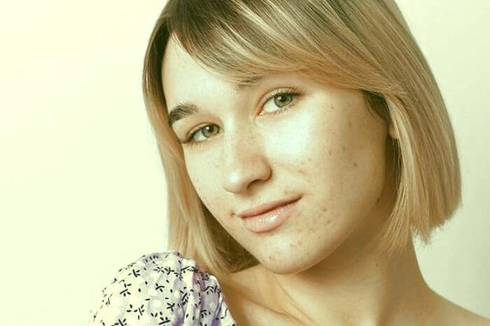 آکنه و سم بدن