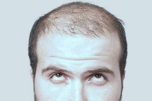 عوارض خطرناک کاشت مو