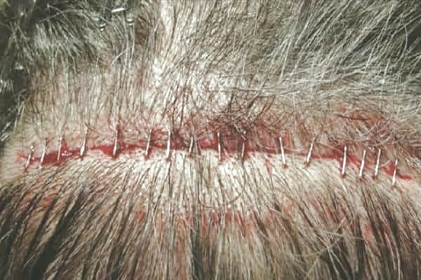 خونریزی بعد از کاشت مو