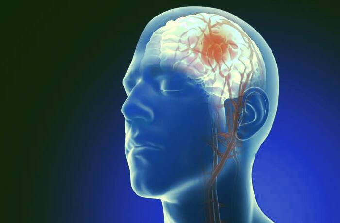 دلیل آنوریسم مغزی