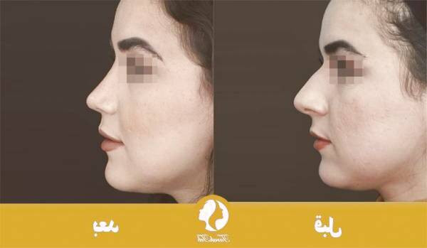 جراحی بینی