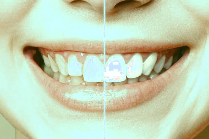 وارنیش دندان