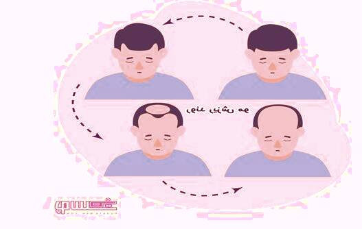 عوامل اصلی ریزش مو - کشف و درمان