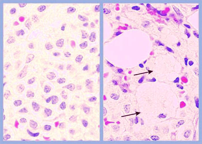 بیماری گوشه