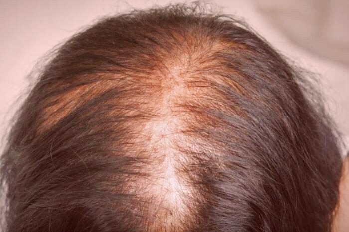 دلیل ریزش مو نوجوانی