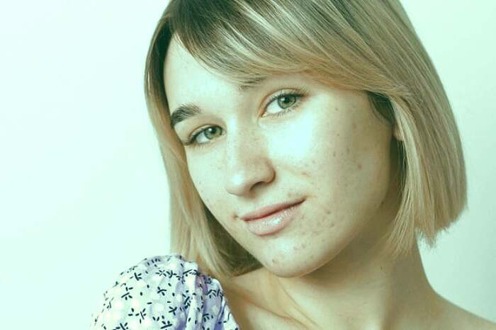 انواع جوش های بلوغ