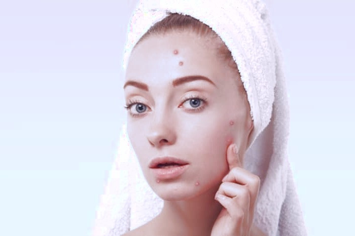 جوش های دوران بلوغ