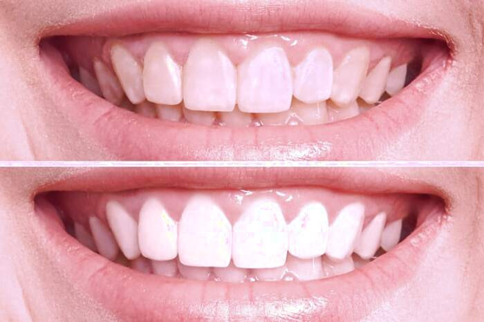 سفید کردن دندانها