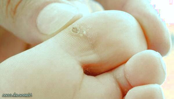 درمان زگیل تناسلی با سرکه سیب