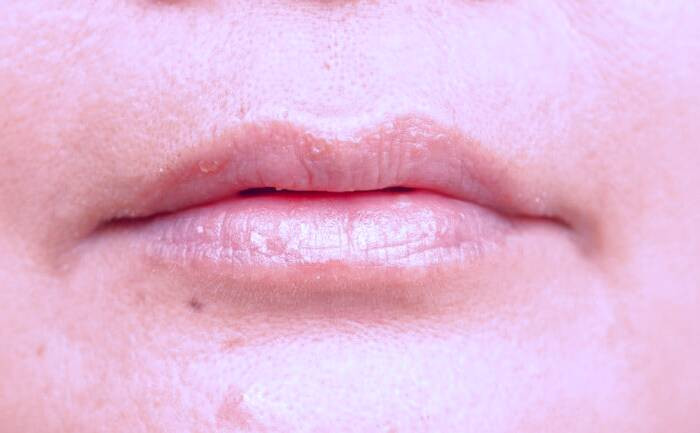 بیماری های خشکی لب