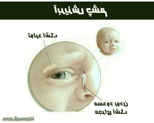 انسداد مجاری اشکی