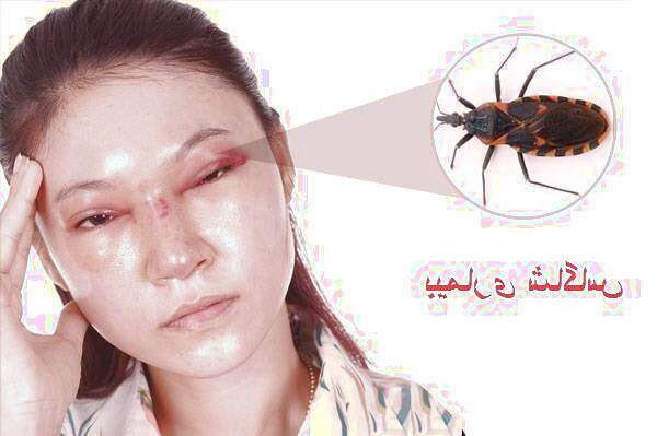 علائم خطرناک بیماری شاگاس  بیماری شاگاس
