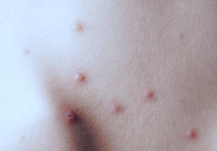 علل آبله مرغان