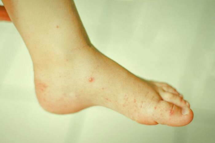 شکل جوشهای ابله مرغان