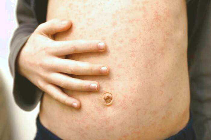 تب در آبله مرغان