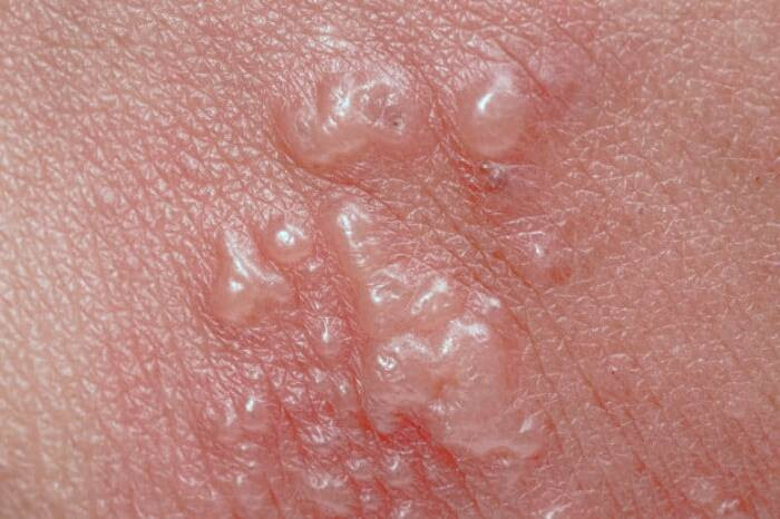 بیماری شینگلز