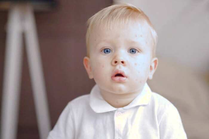 خطر آبله مرغان