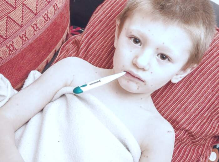 نشانه آبله مرغان