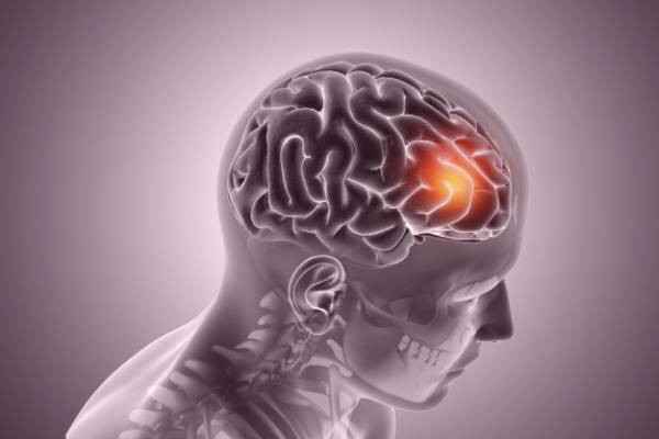 رشد غیر طبیعی سلول مغز تومور مغزی