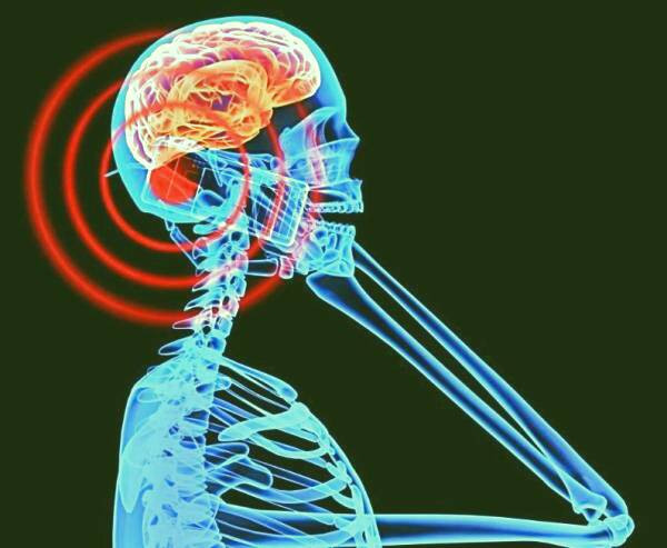 اشعه و تومور مغزی قرار گرفتن در معرض اشعه