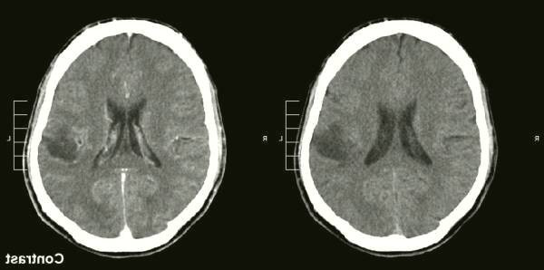 تومورهای مغزی اولیه گلیوماس