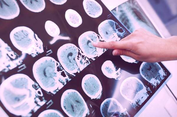 بررسی تومور مغزی نمونه برداری از جمجمه