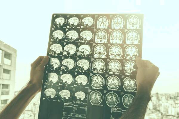 توان بخشی بعد از درمان تومور مغزی توان بخشی