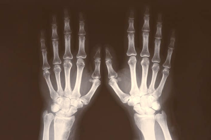 اسکن استخوان دست در سن بالا اسکن استخوان