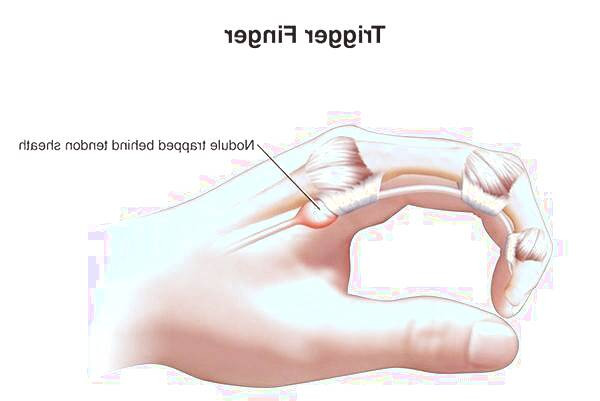 تریگر فینگر