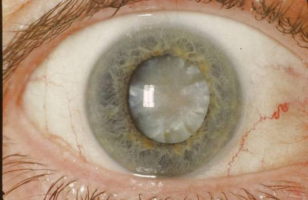 آب سیاه گلوکوم 