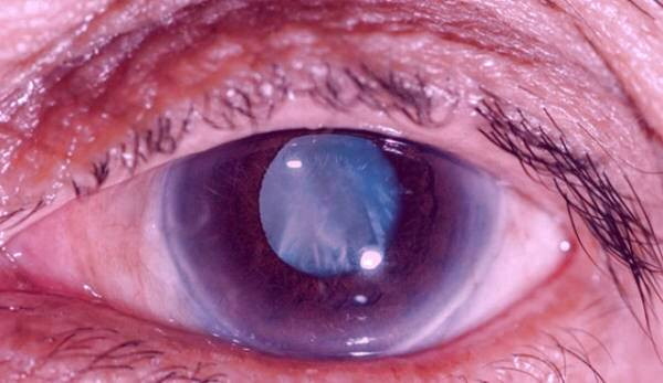 آب سیاه گلوکوم 